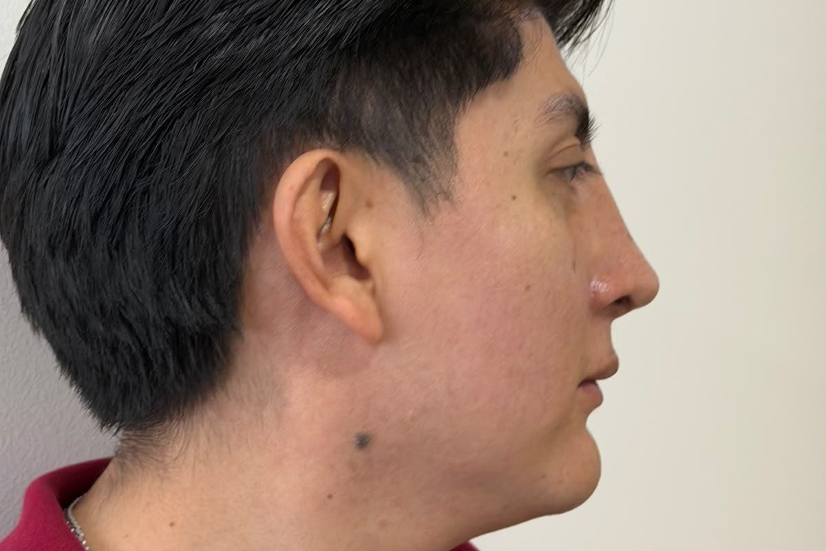 Perfil facial — cirugía facial estética