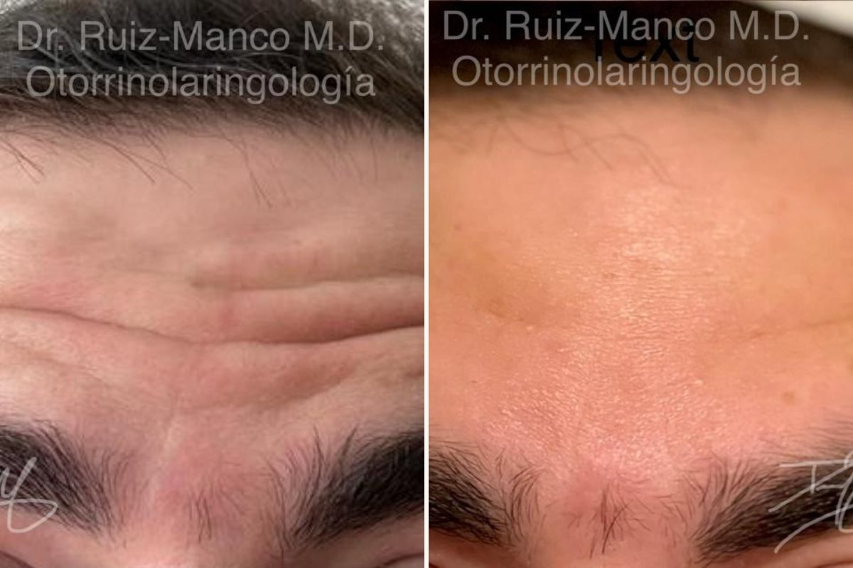 Rejuvenecimiento facial sin cirugía — antes y después