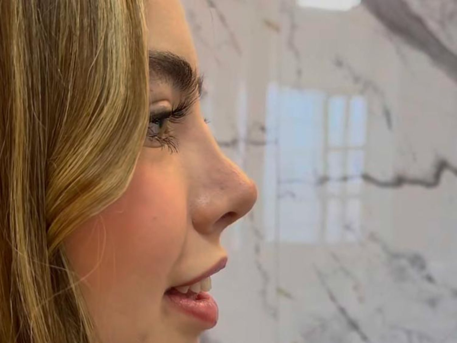 Perfil facial — rinoplastia