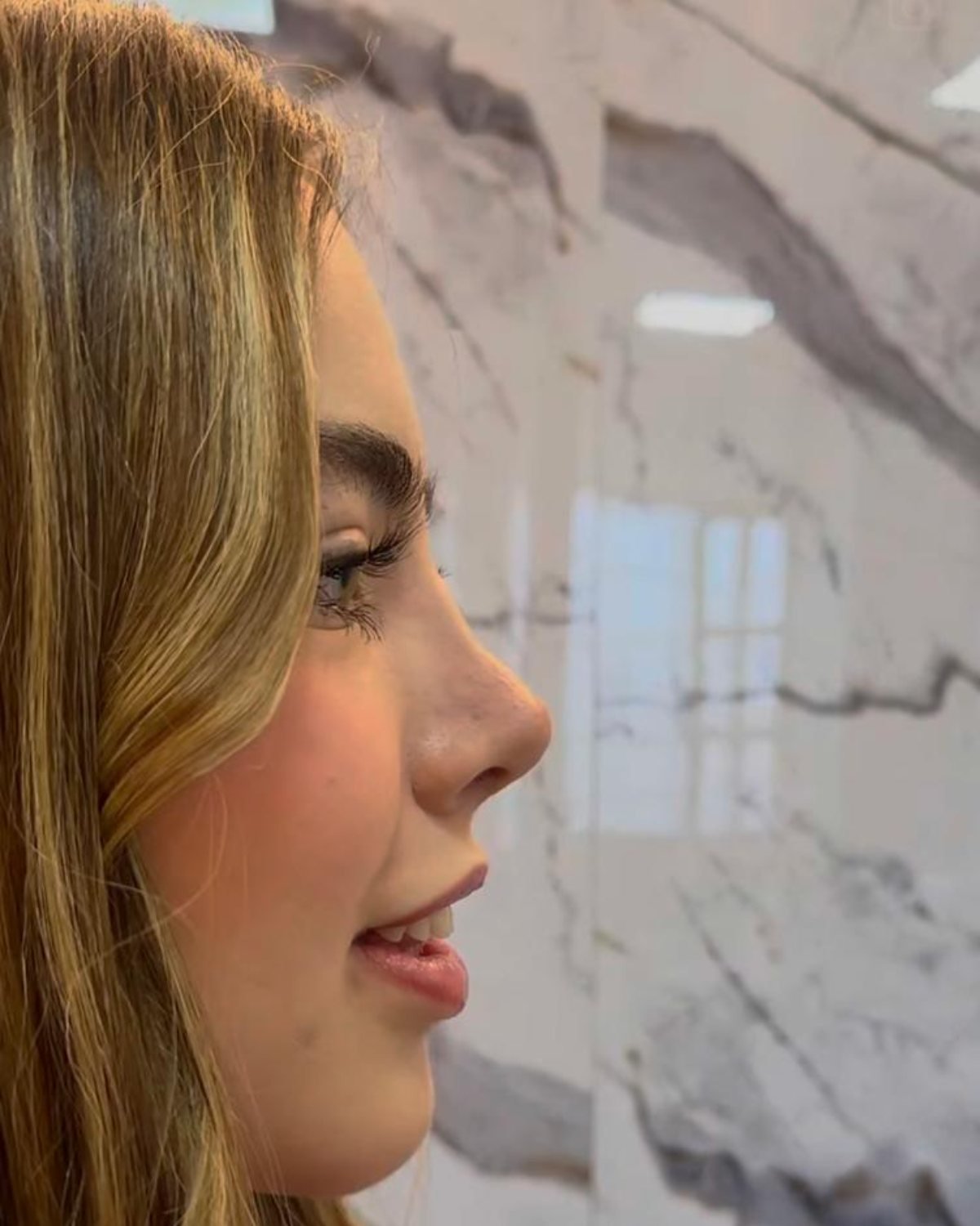 Perfil facial — rinoplastia